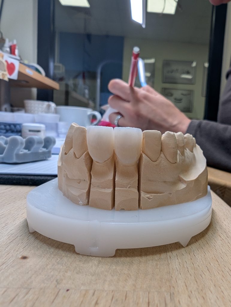 licówki ceramiczne projektujemy w programie CAD/CAM